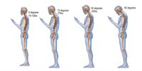 گردن درد پیامکی چیست؟